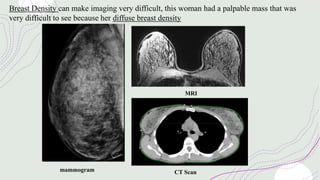 Breast Density can make imaging very difficult, this woman had a palpable mass that was
very difficult to see because her diffuse breast density
mammogram CT Scan
MRI
 
