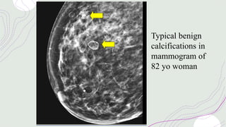 Typical benign
calcifications in
mammogram of
82 yo woman
 