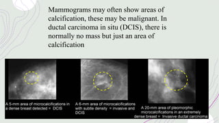 Mammograms may often show areas of
calcification, these may be malignant. In
ductal carcinoma in situ (DCIS), there is
normally no mass but just an area of
calcification
 