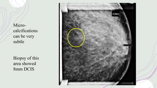 Micro-
calcifications
can be very
subtle
Biopsy of this
area showed
8mm DCIS
 