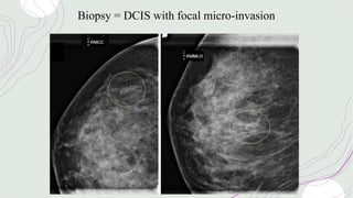Biopsy = DCIS with focal micro-invasion
 