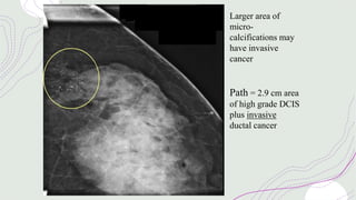 Larger area of
micro-
calcifications may
have invasive
cancer
Path = 2.9 cm area
of high grade DCIS
plus invasive
ductal cancer
 