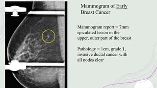 Mammogram report = 7mm
spiculated lesion in the
upper, outer part of the breast
Pathology = 1cm, grade 1,
invasive ductal cancer with
all nodes clear
Mammogram of Early
Breast Cancer
 