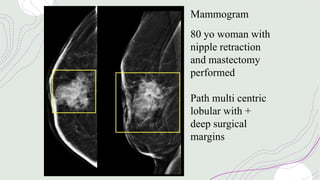 Mammogram
80 yo woman with
nipple retraction
and mastectomy
performed
Path multi centric
lobular with +
deep surgical
margins
 