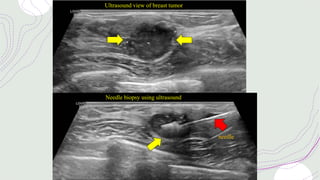 Ultrasound view of breast tumor
Needle biopsy using ultrasound
needle
 