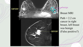 Breast MRI
Path = 2.2 cm
cancer in right
breast, left breast
was benign
(False positive?)
benign
 
