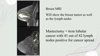 Breast MRI
Will show the breast tumor as well
as the lymph nodes
Mastectomy = 6cm lobular
cancer with 41 out of 42 lymph
nodes positive for cancer spread
 