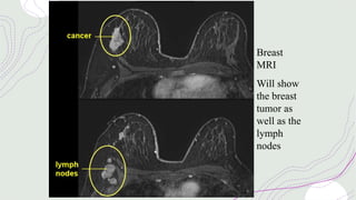 Breast
MRI
Will show
the breast
tumor as
well as the
lymph
nodes
 