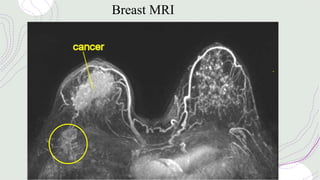 Breast MRI
 