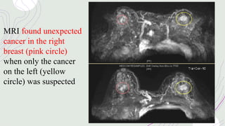 MRI found unexpected
cancer in the right
breast (pink circle)
when only the cancer
on the left (yellow
circle) was suspected
 