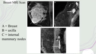 Breast MRI Scan
A = Breast
B = axilla
C = internal
mammary nodes
 