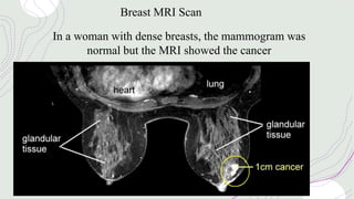 Breast MRI Scan
In a woman with dense breasts, the mammogram was
normal but the MRI showed the cancer
 