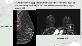 mammogram
Breast MRI
MRI may show deep tumors that can be missed on the edge of
the mammogram images and can be better seen and the depth
on the MRI
 