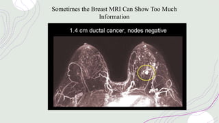 Sometimes the Breast MRI Can Show Too Much
Information
 