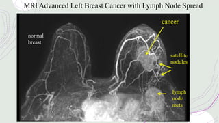 MRI Advanced Left Breast Cancer with Lymph Node Spread
normal
breast
cancer
satellite
nodules
lymph
node
mets
 