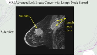 MRI Advanced Left Breast Cancer with Lymph Node Spread
Side view
cancer
lymph
node
mets
 