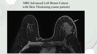 MRI Advanced Left Breast Cancer
with Skin Thickening (same patient)
 
