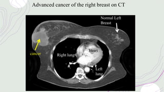 cancer
Normal Left
Breast
Heart
Left
lung
Right lung
Advanced cancer of the right breast on CT
 