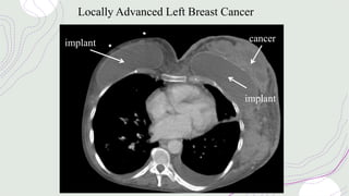 Locally Advanced Left Breast Cancer
implant cancer
implant
 