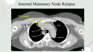 Internal Mammary Node Relapse
IM node
aorta
esophagus
trachea
SVC
 