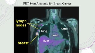 PET Scan Anatomy for Breast Cancer
 
