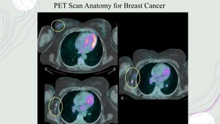 PET Scan Anatomy for Breast Cancer
 