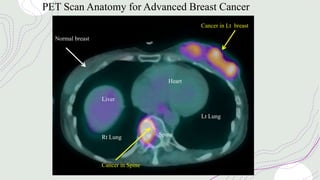 Normal breast
Liver
Heart
Spine
Rt Lung
Lt Lung
Cancer in Lt breast
Cancer in Spine
PET Scan Anatomy for Advanced Breast Cancer
 