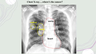 Chest X-ray….where’s the cancer?
heart
aorta
nodes
cancer
 
