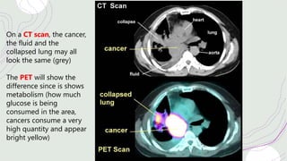 On a CT scan, the cancer,
the fluid and the
collapsed lung may all
look the same (grey)
The PET will show the
difference since is shows
metabolism (how much
glucose is being
consumed in the area,
cancers consume a very
high quantity and appear
bright yellow)
 