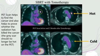 SBRT with Tomotherapy
PET Scan before and 2 Months after Tomotherapy
PET Scan helps
to find the
cancer and also
helps to prove
whether the
radiation has
killed the cancer
(the grey scar
should no
longer be hot
on the PET)
Hot
Cold
 