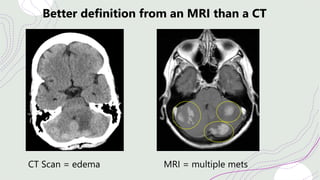 Better definition from an MRI than a CT
CT Scan = edema MRI = multiple mets
 