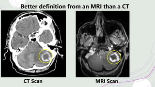 CT Scan MRI Scan
Better definition from an MRI than a CT
 