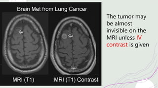 The tumor may
be almost
invisible on the
MRI unless IV
contrast is given
 