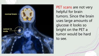 PET scans are not very
helpful for brain
tumors. Since the brain
uses large amounts of
glucose it looks so
bright on the PET a
tumor would be hard
to see.
 