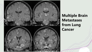 Multiple Brain
Metastases
from Lung
Cancer
 