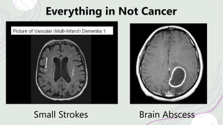 Everything in Not Cancer
Small Strokes Brain Abscess
 