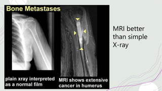 MRI better
than simple
X-ray
 