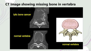 CT Image showing missing bone in vertebra
 