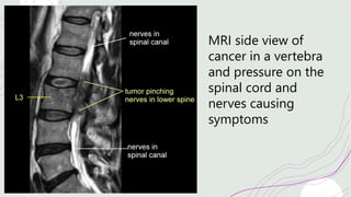 MRI side view of
cancer in a vertebra
and pressure on the
spinal cord and
nerves causing
symptoms
 