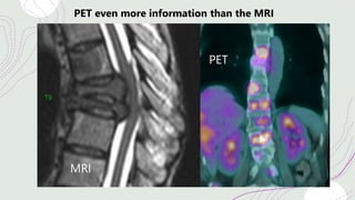 PET even more information than the MRI
MRI
PET
 