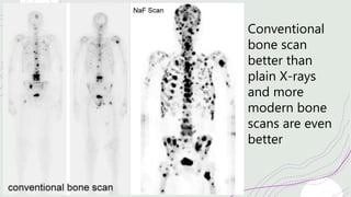 Conventional
bone scan
better than
plain X-rays
and more
modern bone
scans are even
better
 