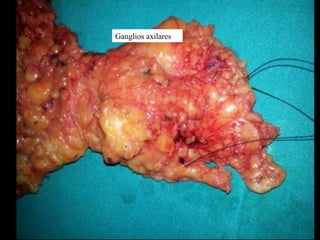 Ganglios axilares
 