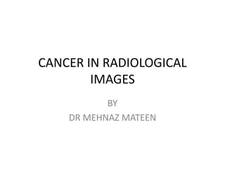 CANCER IN RADIOLOGICAL
IMAGES
BY
DR MEHNAZ MATEEN
 