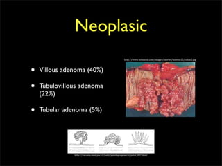Neoplasic
                                                         http://www.boloncol.com/images/stories/boletin15/colon3.jpg




•   Villous adenoma (40%)

•   Tubulovillous adenoma
    (22%)

•   Tubular adenoma (5%)




               http://escuela.med.puc.cl/publ/patologiageneral/patol_097.html
 