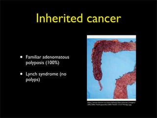 Inherited cancer

•   Familiar adenomatous
    polyposis (100%)

•   Lynch syndrome (no
    polyps)



                           http://www.elsevier.es/sites/default/ciles/elsevier/images/
                           288/288v74n04/grande/288v74n04‐13147781cig1.jpg
 
