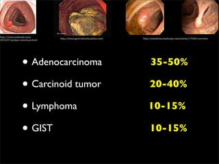 http://www.mdsaude.com/
                                   http://www.gastrointestinalatlas.com/   http://emedicine.medscape.com/article/179284‐overview
2010/07/polipos‐intestinais.html




                  • Adenocarcinoma                                               35-50%

                  • Carcinoid tumor                                             20-40%

                  • Lymphoma                                                   10-15%

                  • GIST                                                        10-15%
 