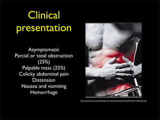 Clinical
presentation
       Asymptomatic
Parcial or total obstruction
            (25%)
   Palpable mass (25%)
  Colicky abdominal pain
         Distension
   Nausea and vomiting
        Hemorrhage
                               http://milennium.net/aikiblog/wp‐content/uploads/2010/09/dolor‐abdomen.jpg
 