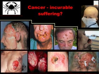 Cancer - incurable
www.dylanmatthews.com/images/cancer.jpg
                                                       suffering?




meddean.luc.edu/lumen/MedEd/.../MELTON/TITLE.HTM             topnews.in/health/files/mouth_cancer_0.jpg        hypnotiqueolmecpunch.org/Strangewomen_1.htm




                                                                                                   students.umf.maine.edu/~delanonh/negative.html
      myhealth.gov.my/.../adult/Breast_Cancer.gif   taconichills.k12.ny.us/.../lungcancerpic.jpg                                            meddean.luc.edu/lumen/MedEd/.../MELTON/TITLE.HTM
 
