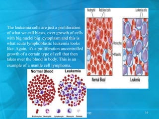 The leukemia cells are just a proliferation
of what we call blasts, over growth of cells
with big nuclei big cytoplasm and this is
what acute lymphoblastic leukemia looks
like. Again, it's a proliferation uncontrolled
growth of a certain type of cell that then
takes over the blood in body. This is an
example of a mantle cell lymphoma.
cancer etiology 16
 