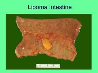 Lipoma Intestine
 